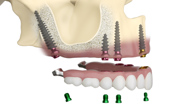pterygoid implants
