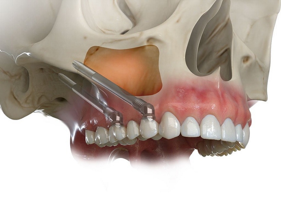 zygomatic implants